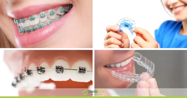 Tipos de aparelho dental, quais são?
