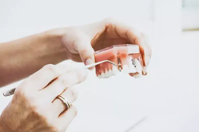 quais os tipos de implante dentario?