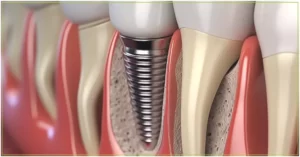 implante dentário - diferença entre implante e prótese