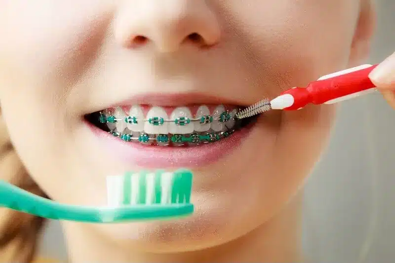 Como escovar os dentes com aparelho