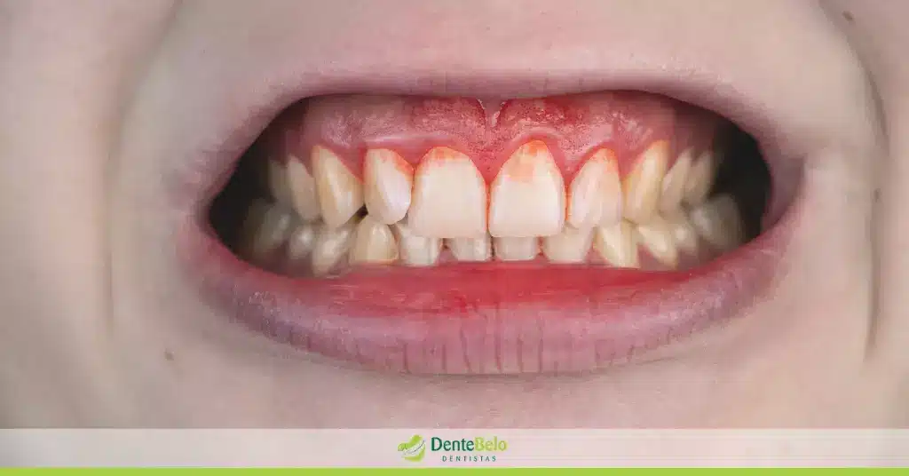 Banner dentebelo post - sinais de doença periodontal