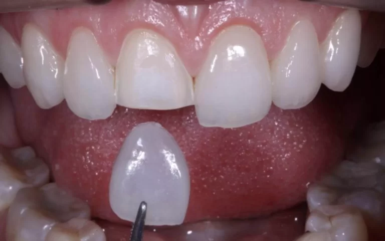 Facetas dentárias: o que são?