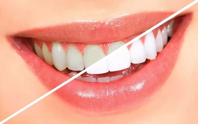 Quais são os tipos de clareamento dental?