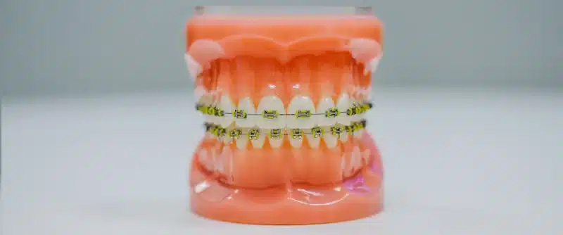 ortodontia e aparelho nos dentes