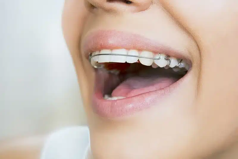 aparelho de contenção e a importância do seu uso para o sucesso do tratamento de alinhamento dos dentes
