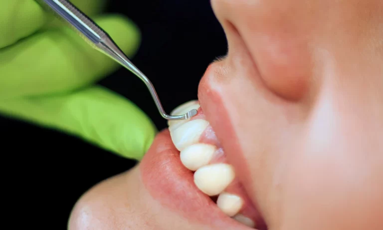 Raspagem periodontal: como funciona este importante tratamento?