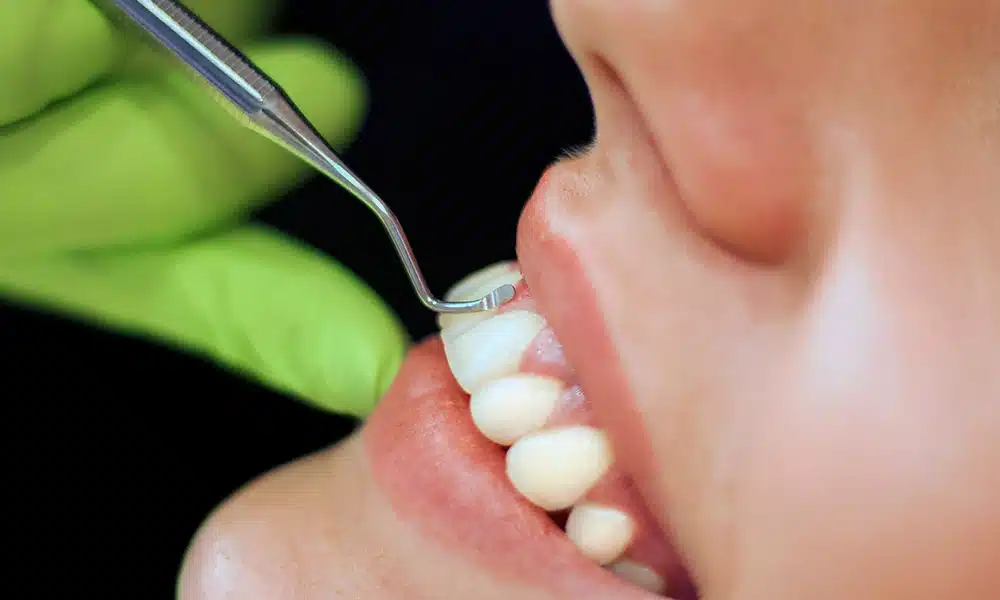 Raspagem periodontal, limpeza dos dentes