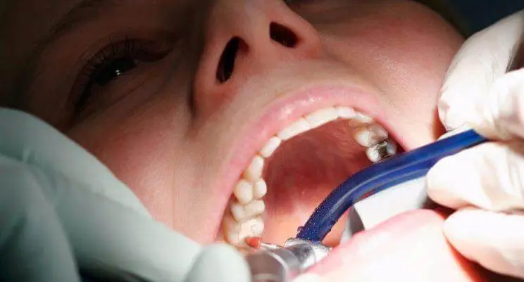 Obturação caiu: saiba o que fazer até ir ao dentista