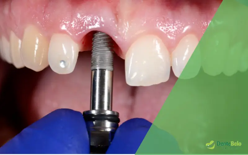 Fazer implantes dentários antes ou depois do tratamento