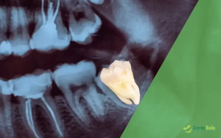 Extração do dente siso: principais informações sobre o dente do juízo