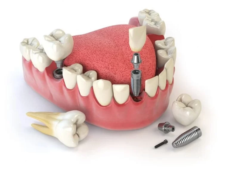Quanto custa um implante dentário?