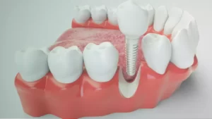 pino de implante na boca