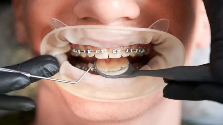 Aparelhos Ortodônticos: o melhor caminho para dentes alinhados